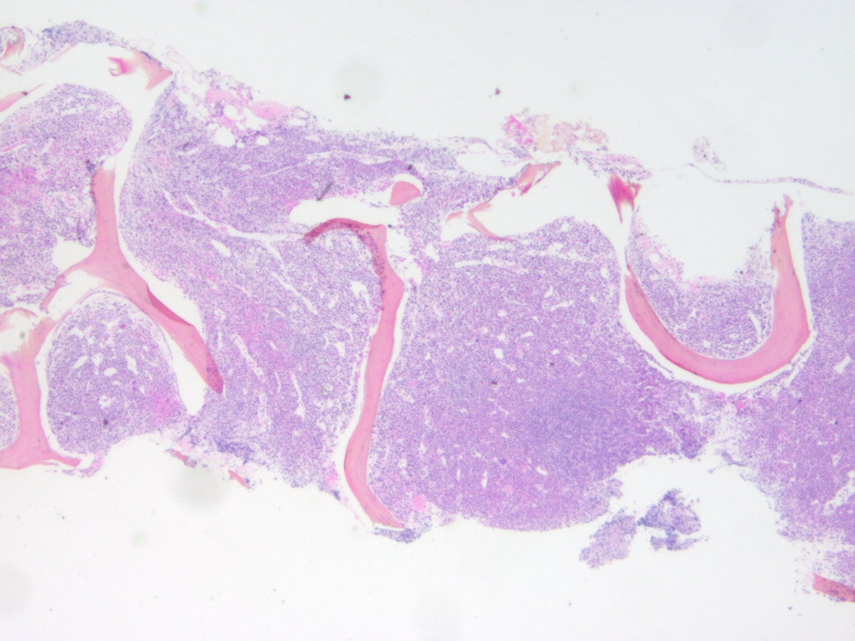 Bone marrow biopsy 2x